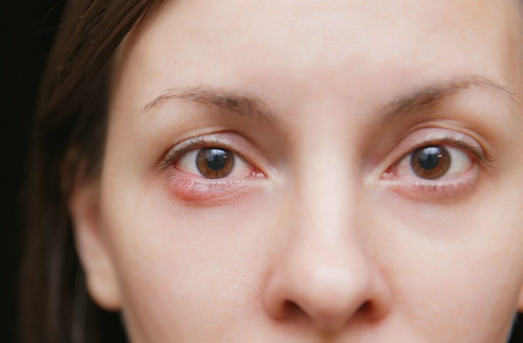 Close-up of redness and swelling on the lower eyelid.